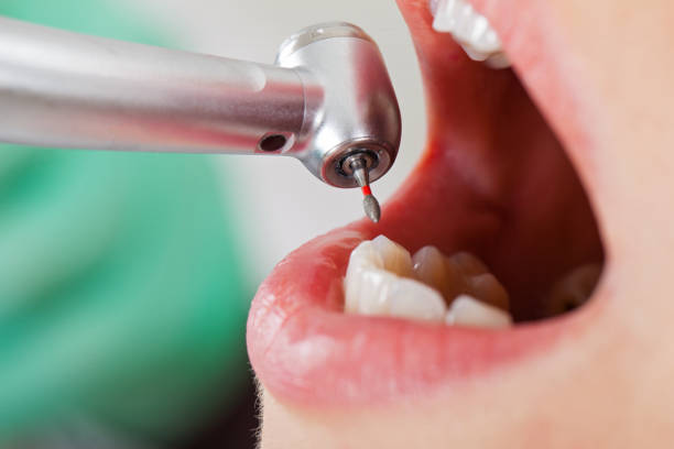 Best Emergency Wisdom Tooth Extraction in Wooster, AR